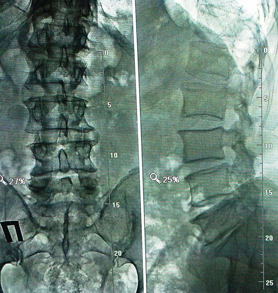 Остеохондроз поясничного отдела l5 s1. Рентген l4-l5 диски. Межпозвоночная грыжа l4-l5. Пояснично-крестцовый отдел рентген l3-4 l4-5 l5-s1. Грыжа диска l3-l4.