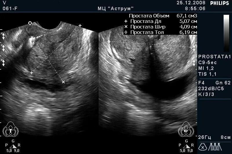 Норматив УЗИ предстательной железы. Норма объема предстательной железы на УЗИ. Норма показателей УЗИ предстательной железы. Измерение объема простаты УЗИ. Показатели предстательной железы