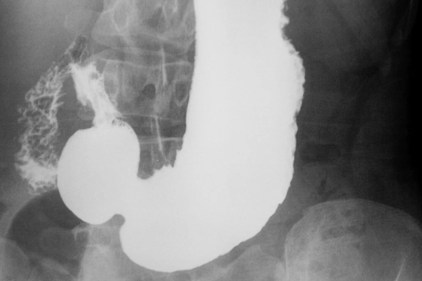 Пищевода с барием. Контрастирование желудка рентген. Рентген желудка с барием язва. Рентгеноскопия желудка с барием язва желудка. Рентгеноскопия желудка норма.