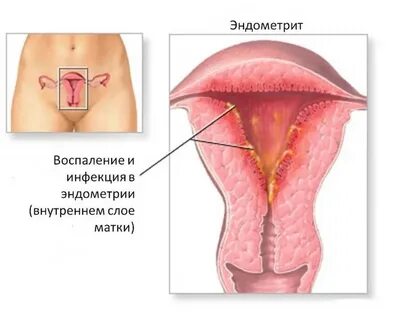 Эндометрий 4 мм форум