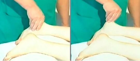 плантарный фасциит стопы массаж. массаж при пяточной шпоре. массаж ног. лечебная физкультура при пяточной шпоре. массажер для пяточной шпоры.