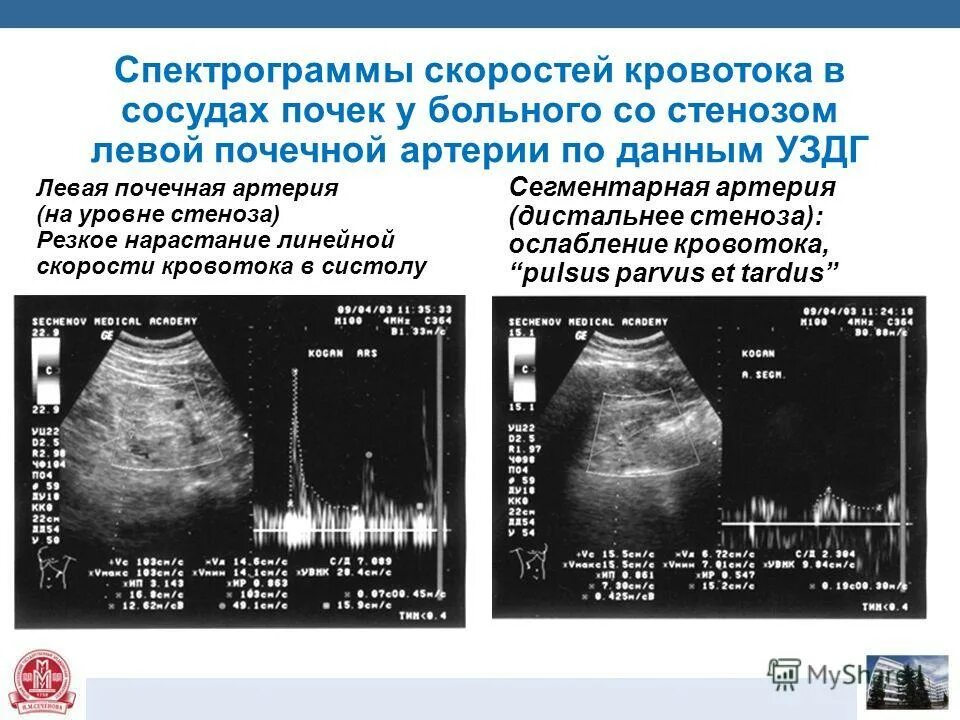 Доплер почек. УЗИ почек допплер сосудов почек. Допплеровское исследование сосудов почек. Допплер сосудов почек норма. Дуплексное сканирование сосудов почек УЗИ.