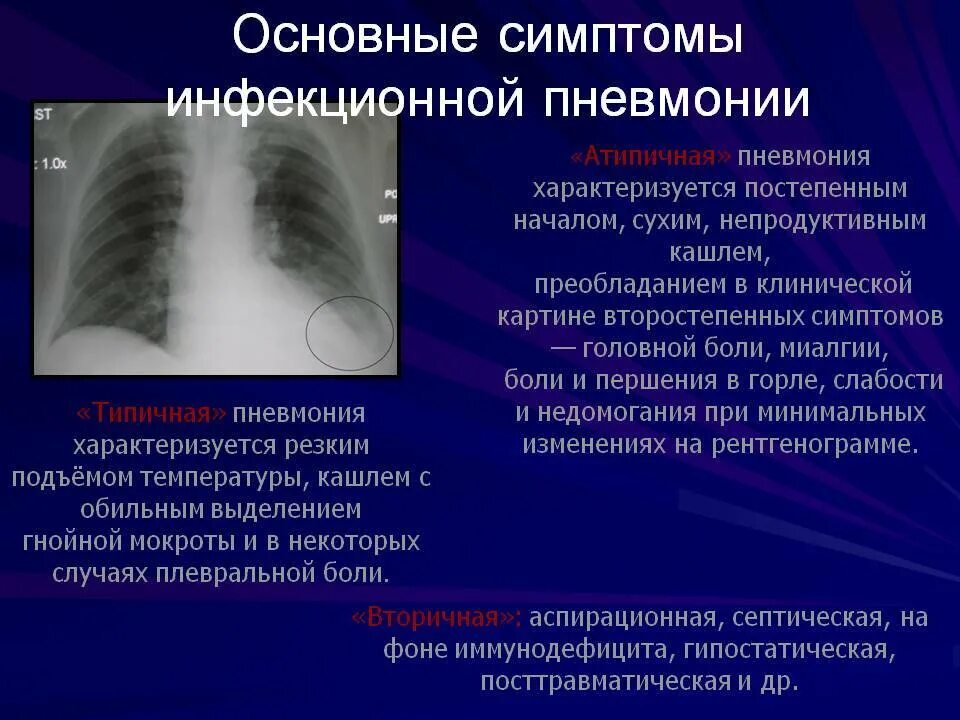 Признак воспаления легких у взрослых с температурой. Пневмония симптомы у взрослых. Симптомы при пневмонии у взрослых.