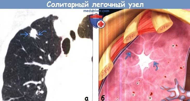 Узлы в легких что это. Солитарный легочный узел на кт. Узелковое образование в легких что это. Узелковые уплотнения в легких.