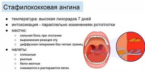 Чем лечить ангину у ребенка