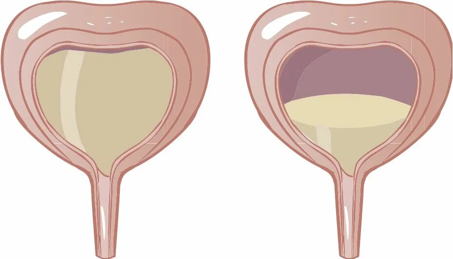 Расслабленный мочевой пузырь. Гиперреактивный мочевой пузырь. Переполненный мочевой пузырь. Переполнение мочевого пузыря. Опорожнение мочевого пузыря.
