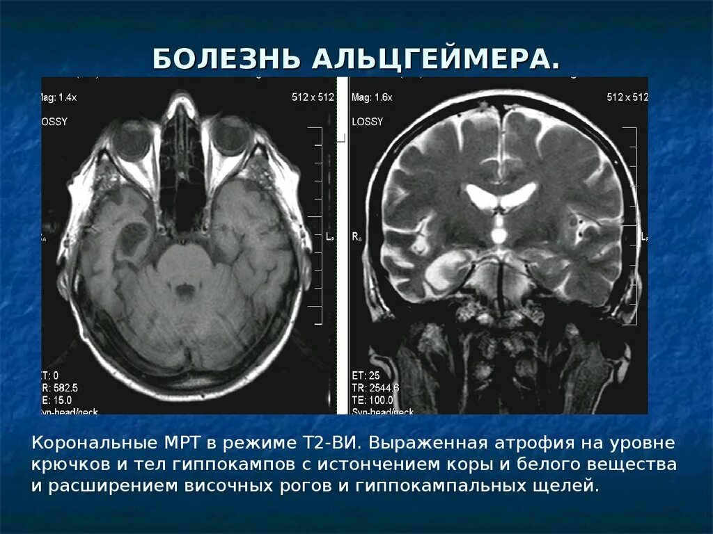 Нейродегенеративное заболевание головного. Нейродегенеративные изменения на мрт. Нейродегенерация головного мозга. Нейродегенеративные заболевания мрт. Нейродегенерация головного мозга мрт.