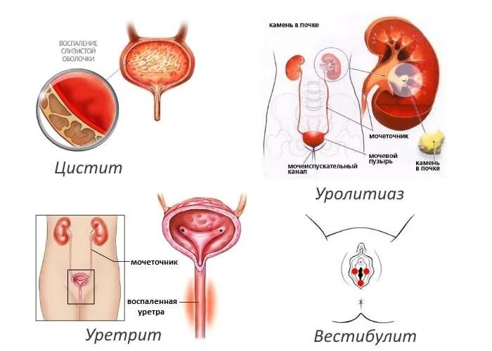 После мочевого. Жжение при мочеиспускании у мужчин. Цистит уретрит у женщин.