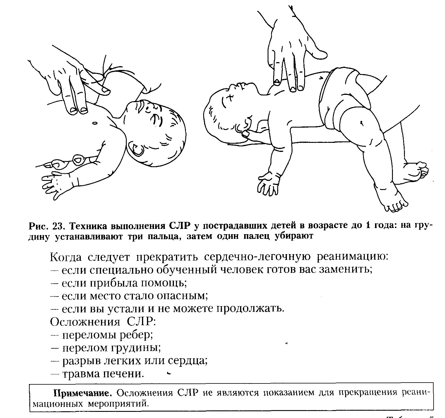 Проведение сердечно легочной реанимации ребенку. Сердечно-лёгочная реанимация у детей до 1 года. сердечно легочная реанимация ребенку до года. непрямой массаж сердца у детей до 1 года.