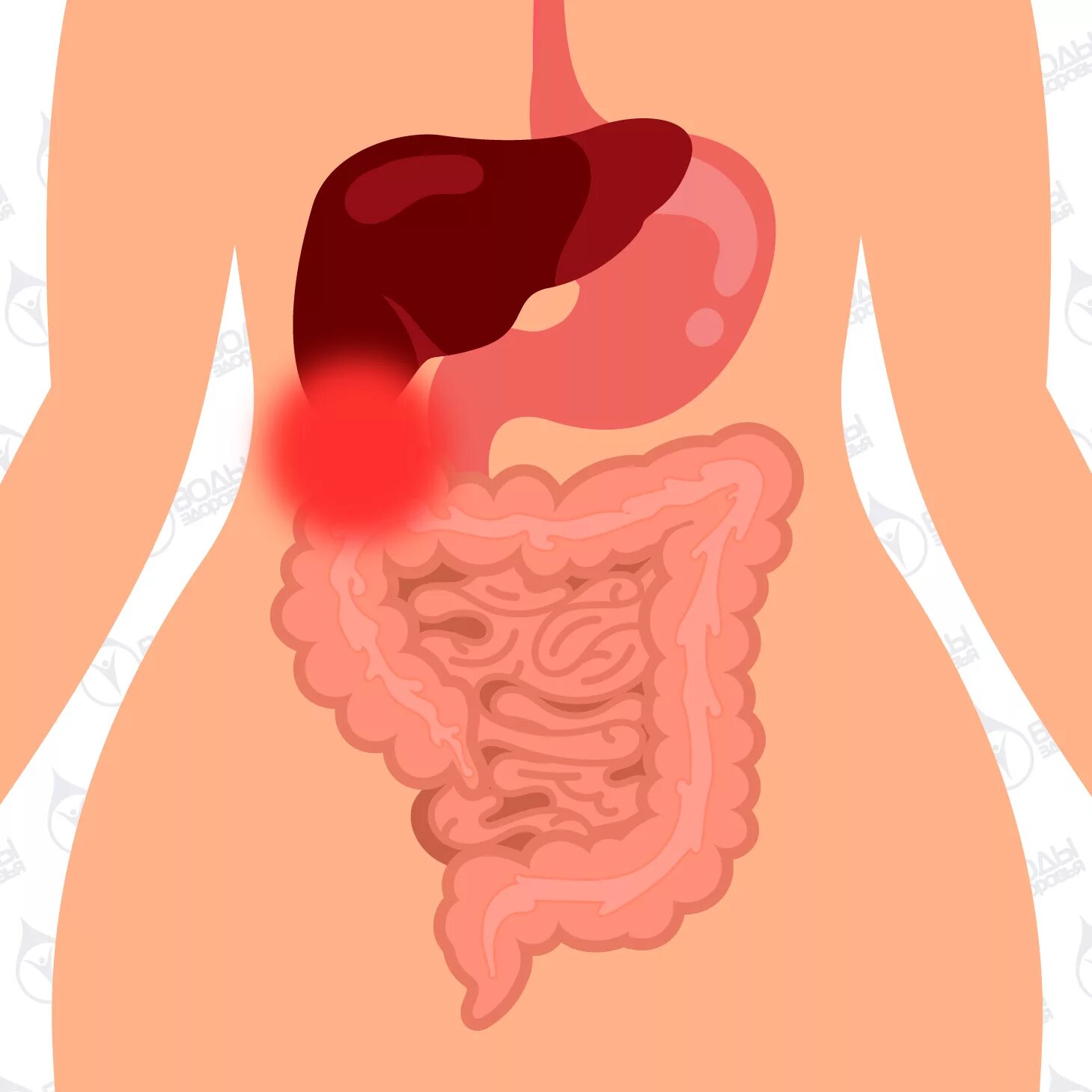 Вздуло кишечник болит. Воспаление кишечника энтерит. Сильное вздутие живота и газообразование. Вздутие и дискомфорт в кишечнике. Вздутие живота картинки.