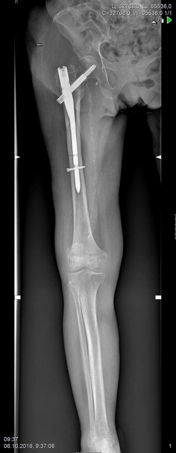 Снимок ноги рентген. Рентгенограмма нижних конечностей.