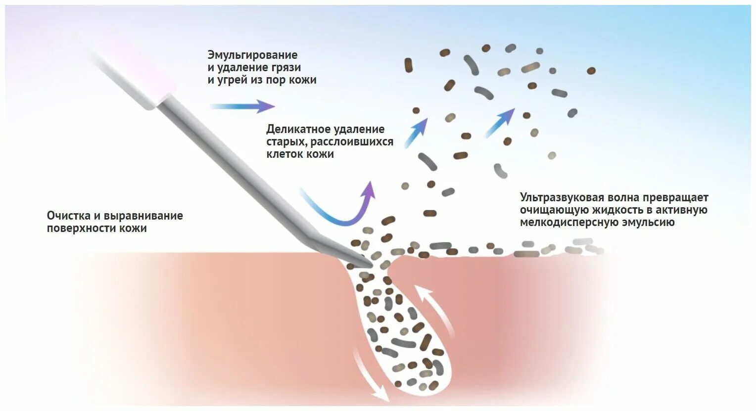 Ультразвуковая чистка лица скраббер. Ультразвуковая чистка лица схема. Протокол чистки лица ультразвуком. Как часто можно делать ультразвуковую чистку