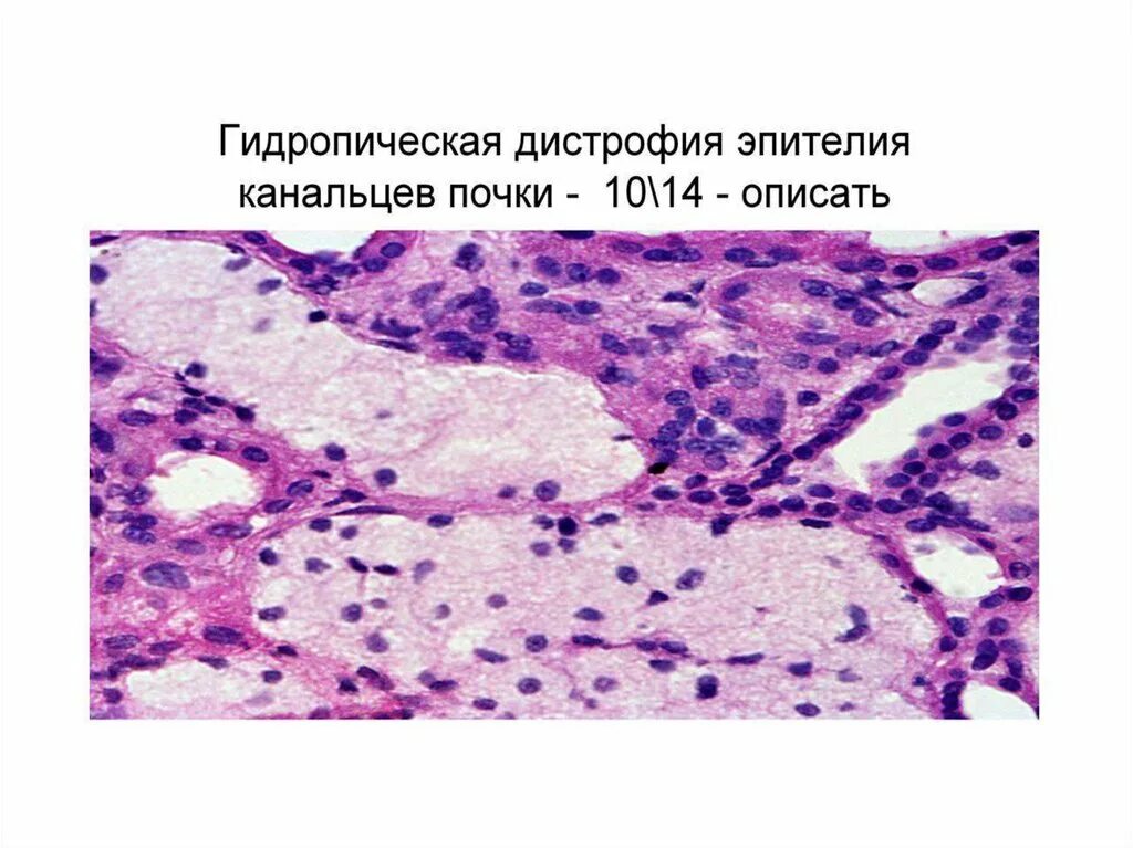 Диффузная дистрофия. 2. Гидропическая дистрофия. Углеводные дистрофии патанатомия. Гидропическая белковая дистрофия. Гидропическая дистрофия гепатоцитов.