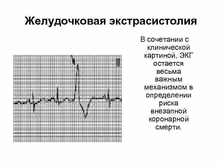 Риск экстрасистолии huawei. Желудочковые экстрасистолы на экг. экг при желудочковой экстрасистолии. желудочковые экстрасистолы на экг характеризуются:. экстрасистолия пульс.