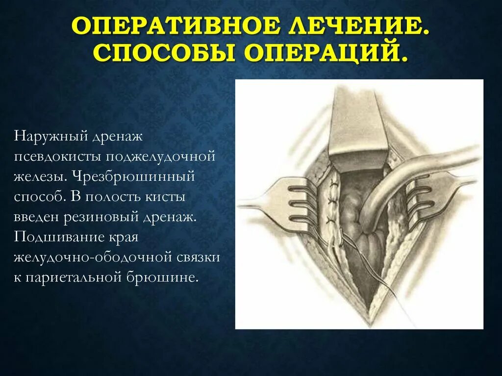 Способы операции простаты. Метод операции абрамсона. зоны декомпрессии забрюшинного пространства при панкреонекрозе. операция по способу крайзельбурда.