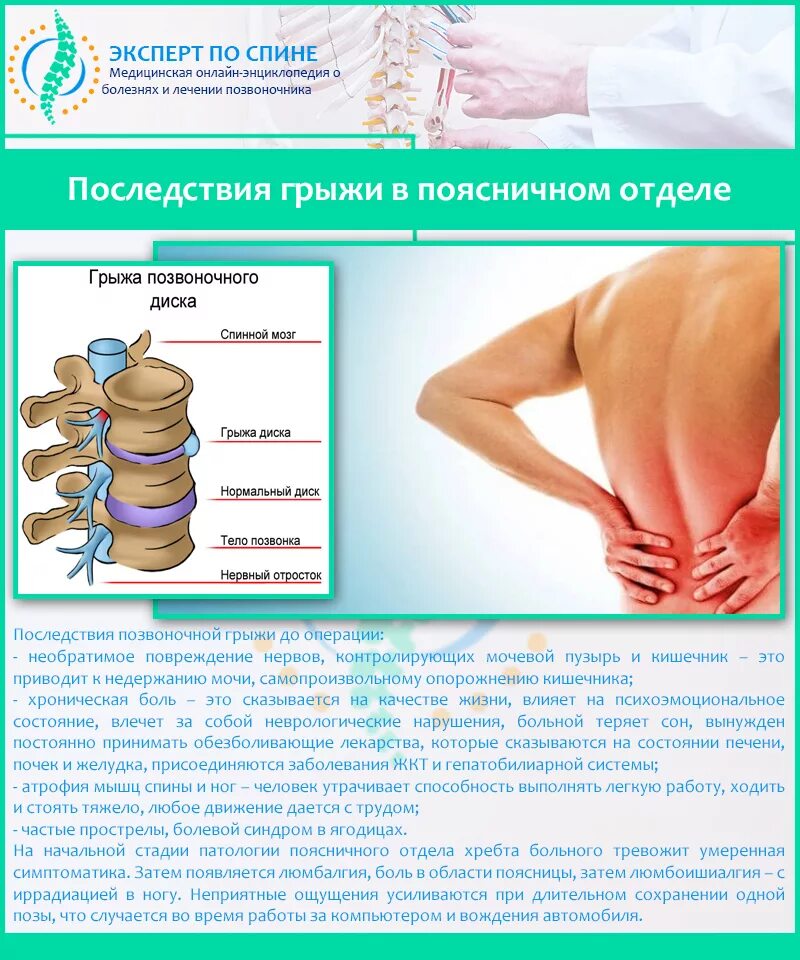 Сильные боли грыжа позвоночника. Грыжа диска позвоночника симптомы. Грыжа позвоночника поясничного отдела симптомы. Позвоночник с грыжей в пояснице. При грыже поясничного отдела позвоночника.