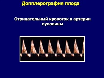 Кровоток в пуповине