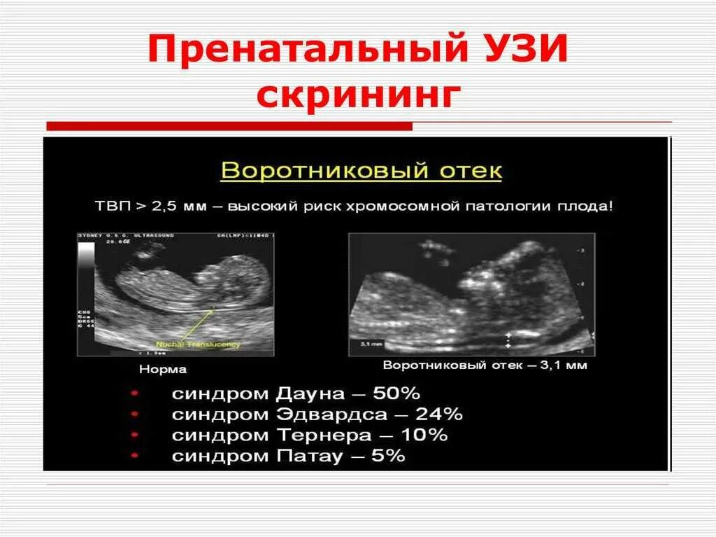 Как отличить на узи