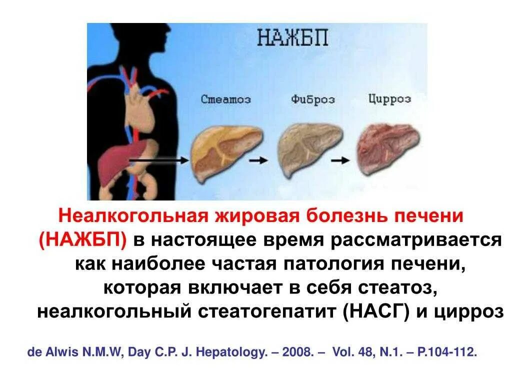 Печень больная жировой. Неалкогольная жировая болезнь печени (НАЖБП). Жировая дистрофия печени(жировой гепатоз). Жировая дистрофия печени (стеатоз печени). Болезнь печени жировой гепатоз.