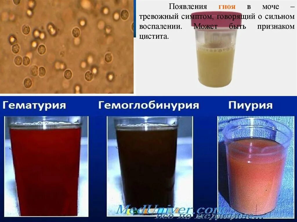 Налет в моче. Гематурия пиурия. осадок мочи. гнойв мояе. неорганический осадок в моче.