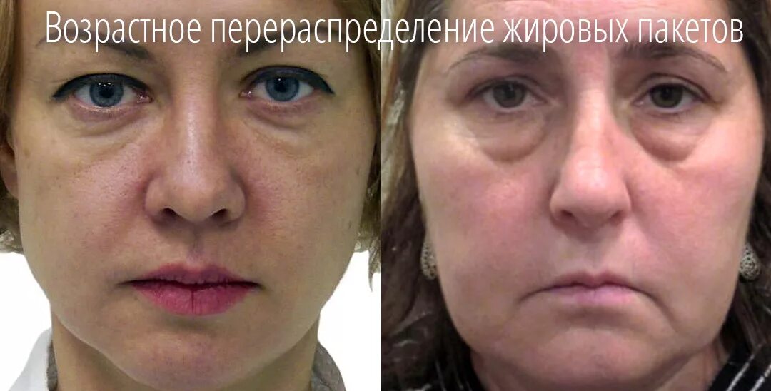 Безоперационная блефаропластика. Пластика глаз до и после. Морщины до после. Нижняя блефаропластика. Липолитики в веки.