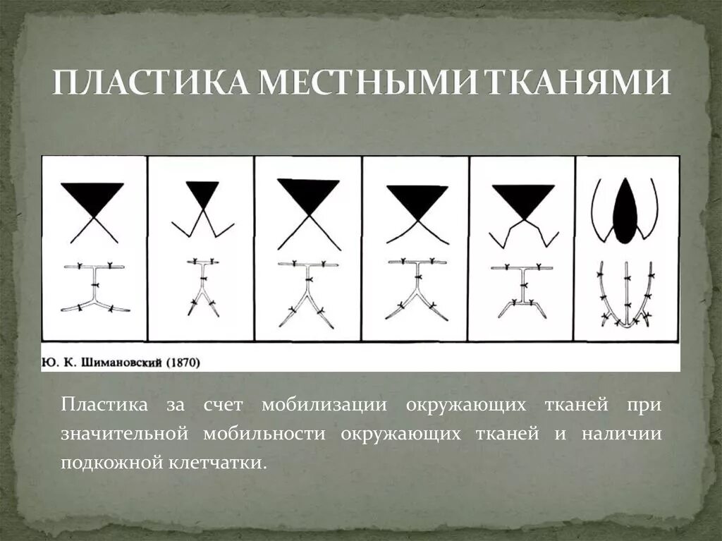 А. Методики пластики местными тканями осложнения. Виды местной пластики. Пластическая хирургия презентация. Пластика местными тканями по шимановскому.