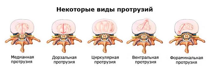 Диффузное выбухание межпозвоночного. Дорзальная медианная протрузия диска l5-s1. Протрузии диска l2-l5 5мм. Задняя медианная протрузия диска l5/s1. Медианная дорзальная протрузия l2/3.