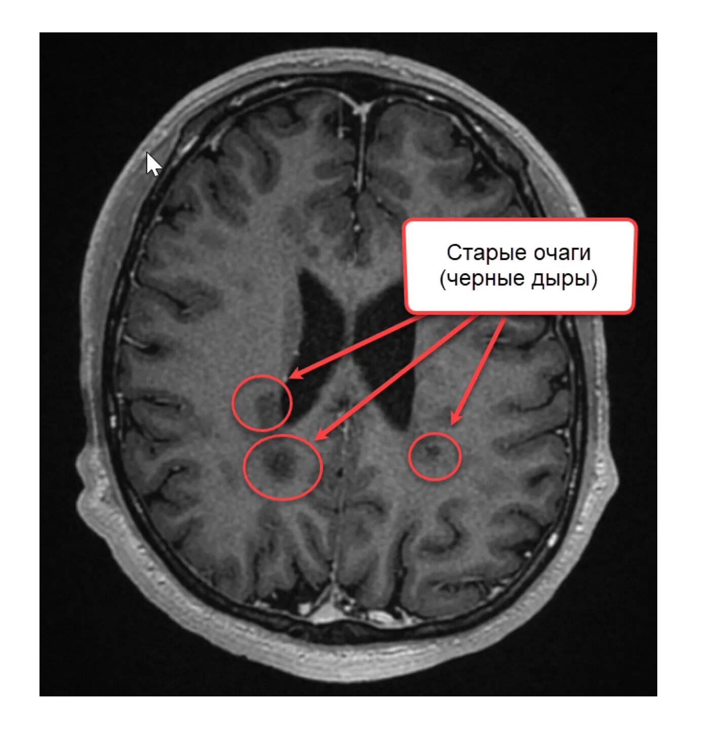 Склероз мозга. Рассеянный склероз снимок мрт. Рассеянный склероз снимки мрт. Рассеянный склероз на мрт т1. Очаги при рассеянном склерозе мрт.