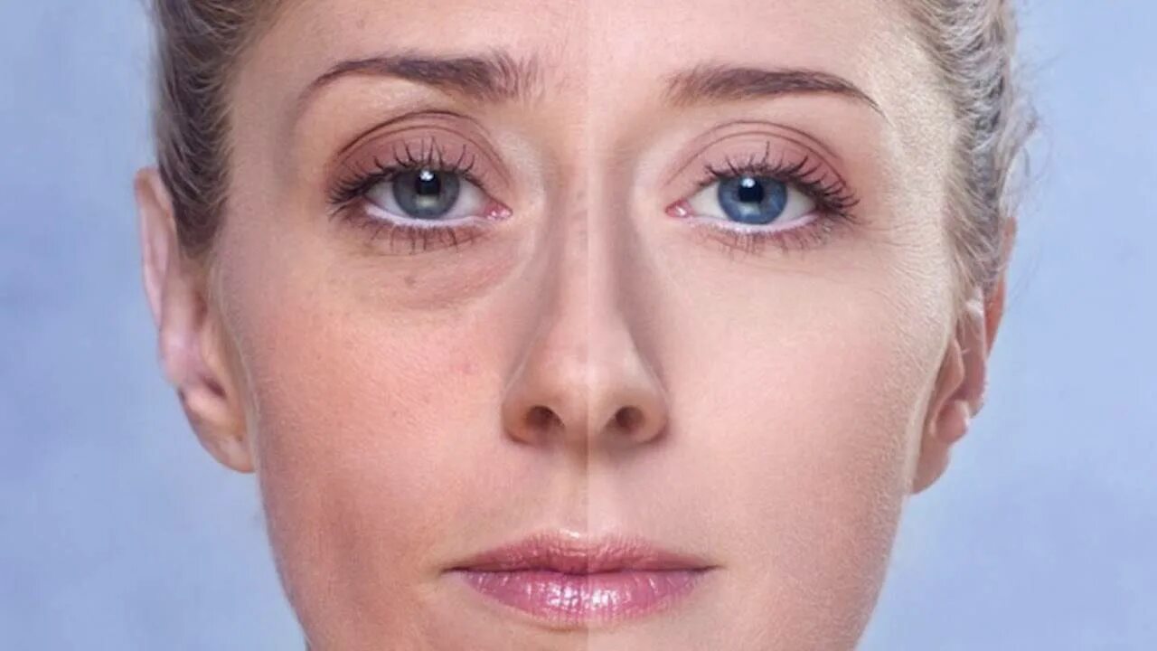 Темные пятна под глазами. Треугольные глаза. Бернара-горнера (птоз, миоз, энофтальм). Впалые глаза и темные круги. Складки под глазами.