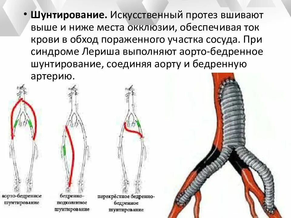 Синдром Лериша аорто бедренное шунтирование. Перекрестное бедренно-бедренное шунтирование техника схема. Синдром поражения бифуркации аорты. Операция при синдроме Лериша.