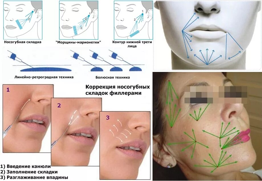 Коррекция подбородка филлерами схема. Техника введения филлера в Марионетки схема. Веерная техника введения филлеров схема.