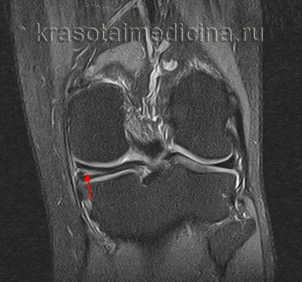 Менисцит коленного сустава мрт. Столлер 3а разрыв мениска.