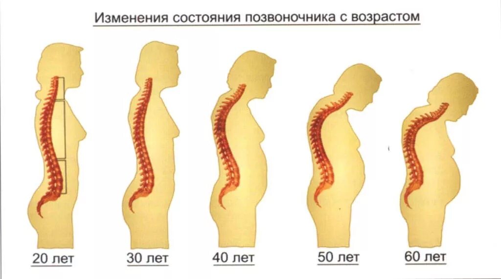 Изменения связанные с возрастом. Лордоз и кифоз позвоночника. Позвоночник человека лордоз кифоз. Позвоночник заболевания кифоз лордоз. Кифоз позвоночника 2 степени.