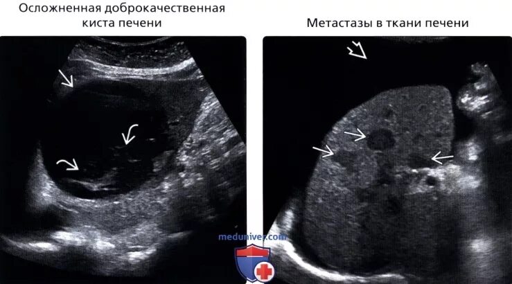 Аваскулярное образование в печени. Гипоэхогенные образования в печени метастазы. Гипоэхогенное образование в печени на УЗИ что это такое. Неоднородное образование в печени на УЗИ. Гиперэхогенные образования в печени на УЗИ.