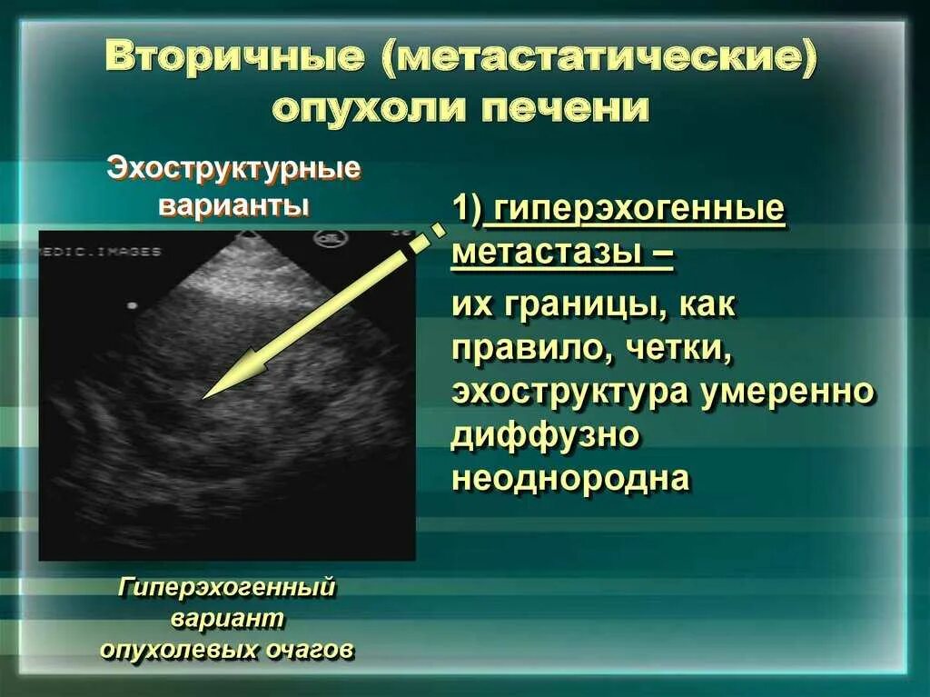 Как отличить метастазы