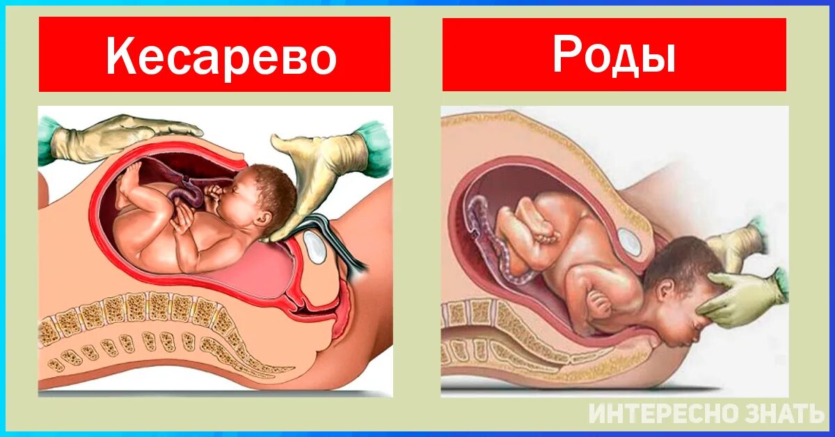 Каких двух родов были мужчины перечислите. Естественные родовые пути. Рождение ребенка кесарево сечение.