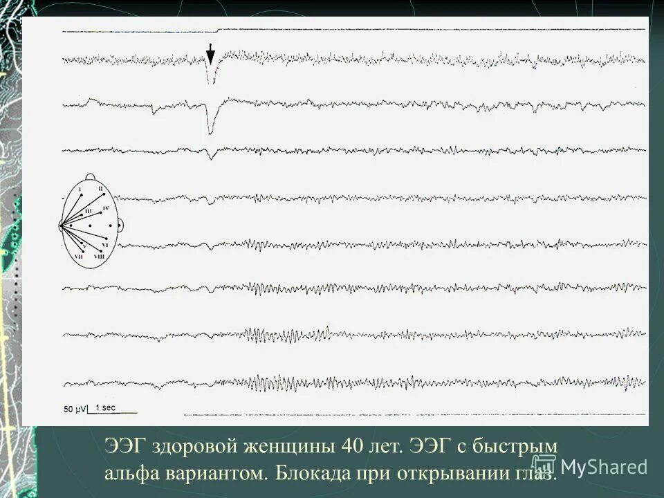 Норма ээг у детей 6 лет. Ээг головного мозга ребенку. Ээг 2 года. Реакция усвоения ритма на ээг. Ггс в ээг.