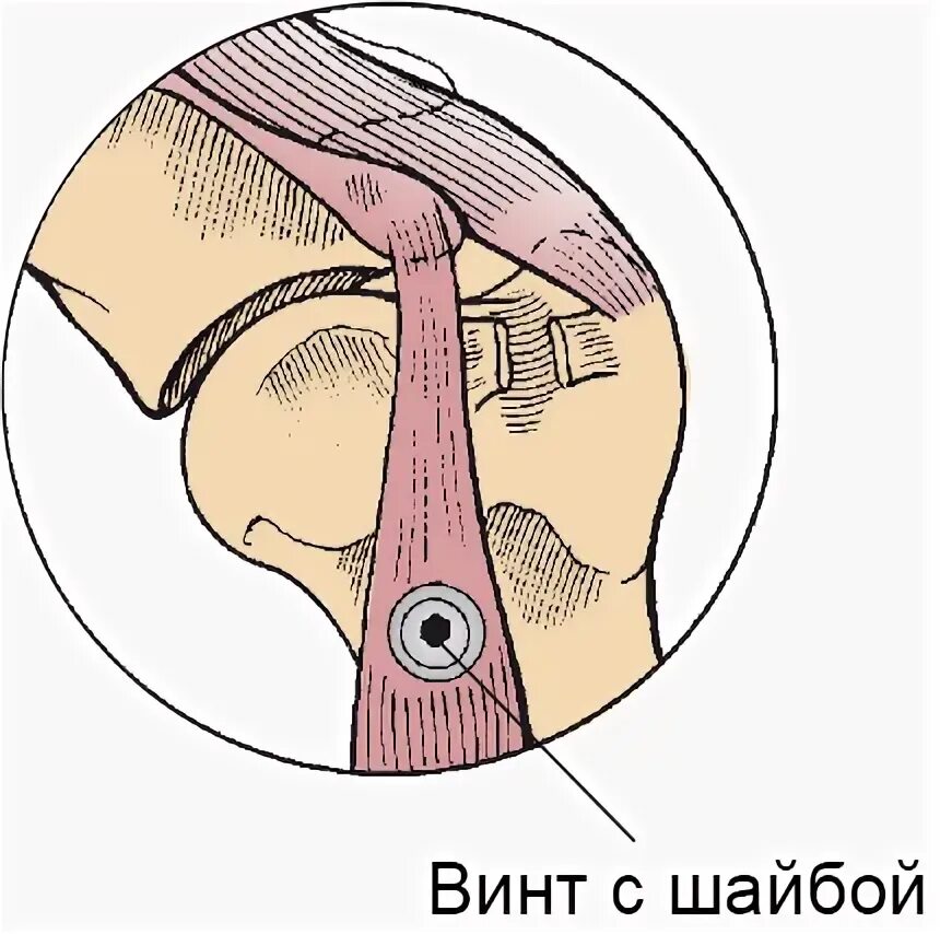 Тенодез сухожилия