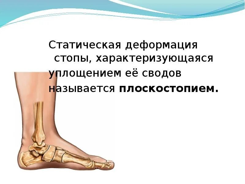 Нарушения стопы. Статическое плоскостопие. статическая деформация стопы. искривление свода стопы. деформация стопы характеризующаяся уплощением ее сводов.