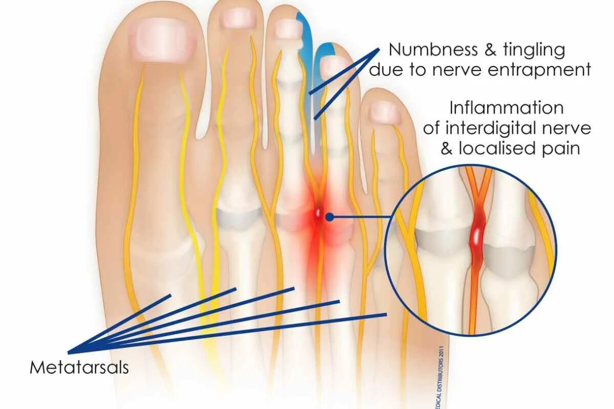 Метатарзалгия стопы. Метатарзалгия стопы. Метатарзалгия стопы. Синдром мортона неврома мортона. Метатарзалгия правой стопы.