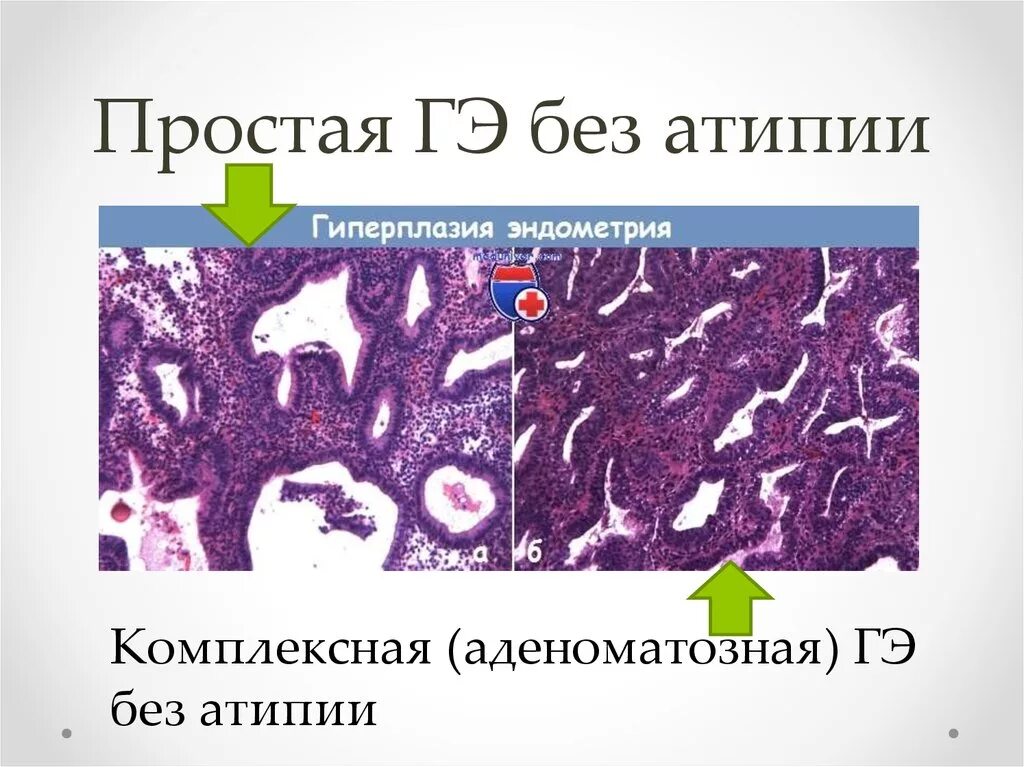 Атипическая гиперплазия гистология. Гиперплазия эндометрия с атипией гистология. Гиперплазия эндометрия без атипии гистология. Гиперплазия эндометрия патанатомия. Железо и эндометрий