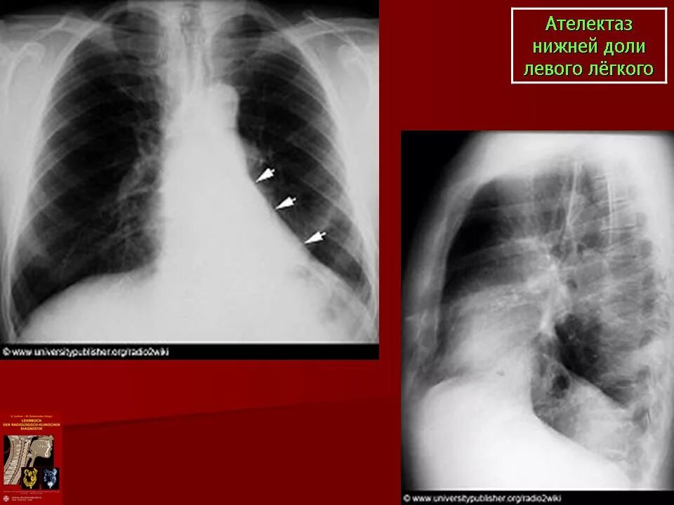 Ателектаз верхней доли рентгенограмма. Ателектаз s1 справа рентген. Ателектаз нижней доли легкого. Ателектаз верхней доли левого легкого кт. Покалывание левого легкого