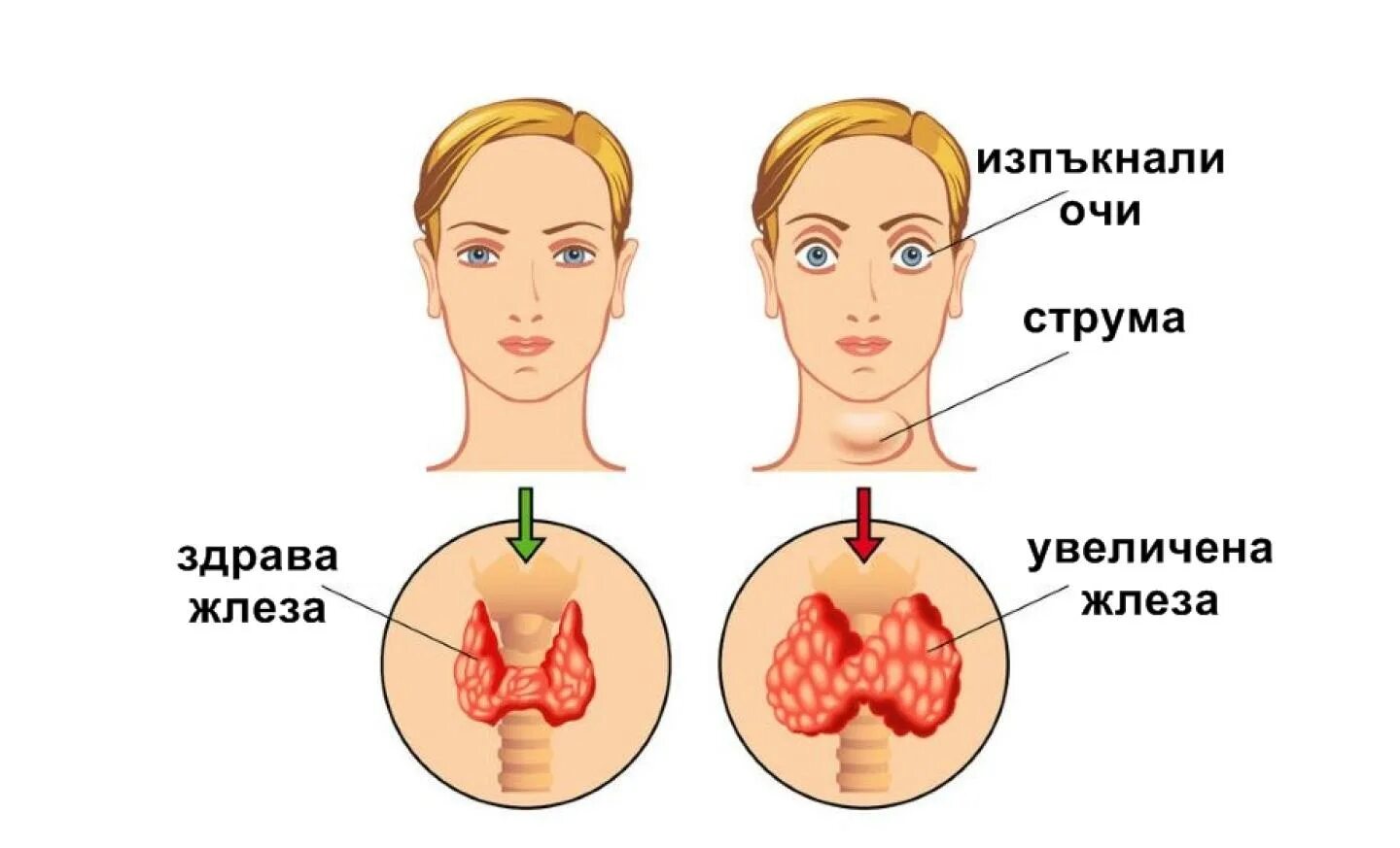 Заболевания щитовидки. Патология щитовидной железы симптомы. Гиперфункция щитовидной железы.