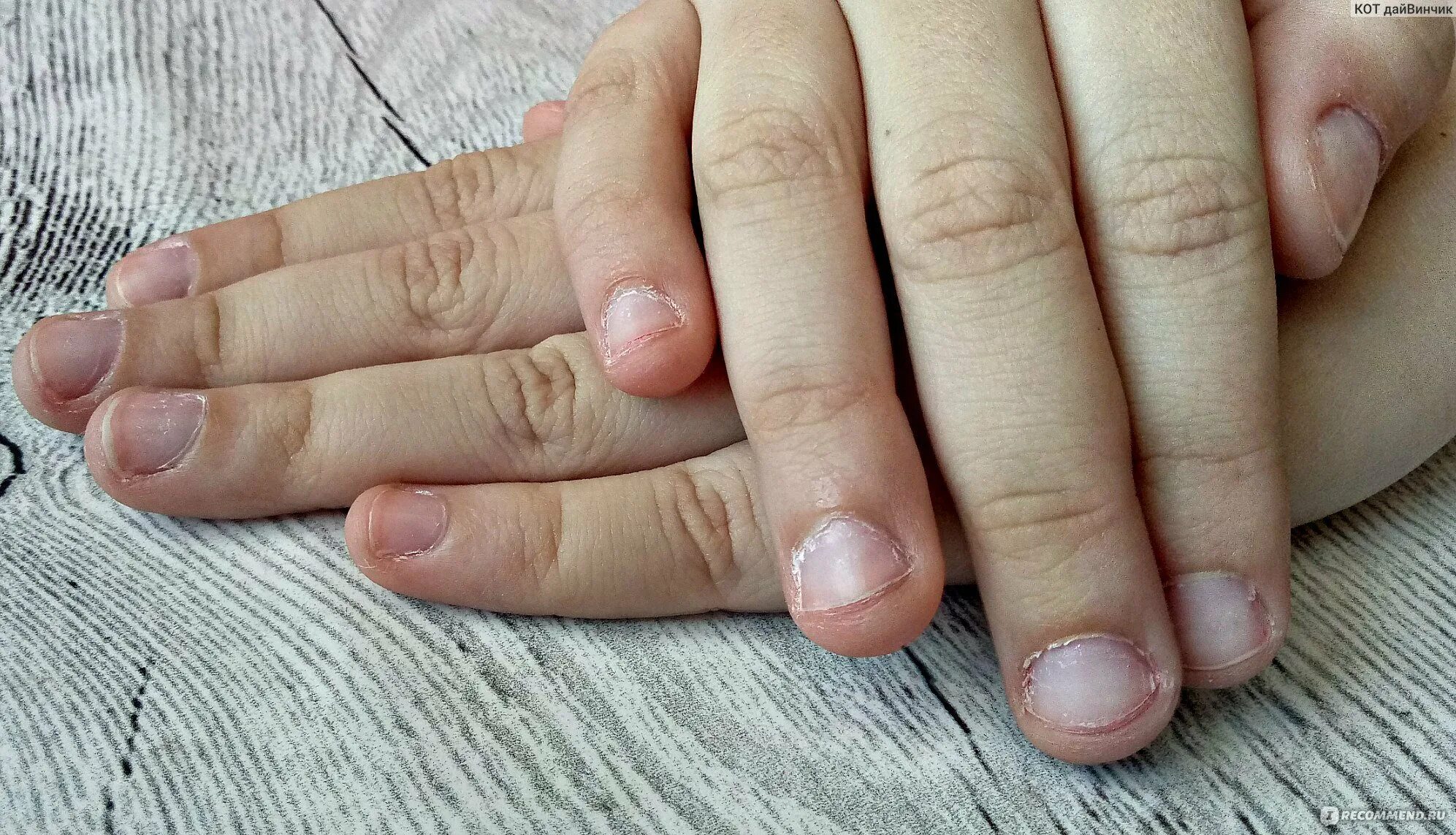 Стричь когти хомяку джунгарику. Ужасные ногти без маникюра. Ногти грызунов. Маникюр с прожилками. Обгрызанные ногти у детей.