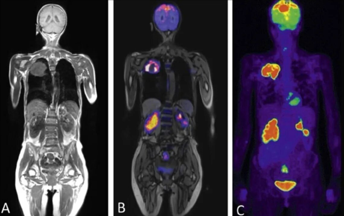 Pet ct. Позитронно-эмиссионная томография метастазы. Позитрон-эмиссионная  томография: ПЭТ. ПЭТ кт с глюкозой. ПЭТ/кт Discovery Pet/CT 610.