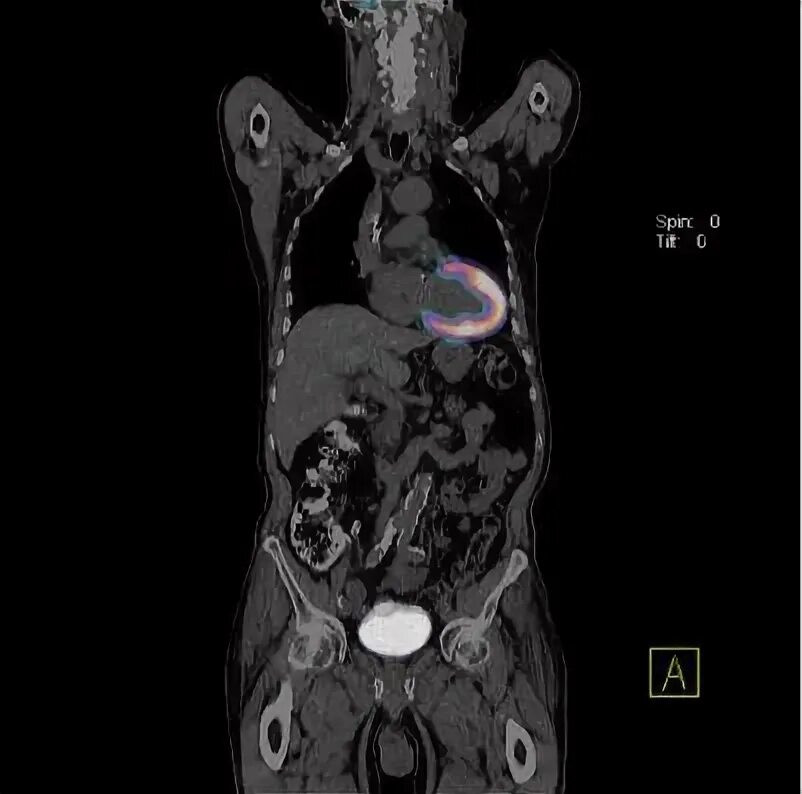 Кт с галлием. Кт с галлием. Пэт кт с галлием. Кт с галлием. Positron emission tomography technology image.