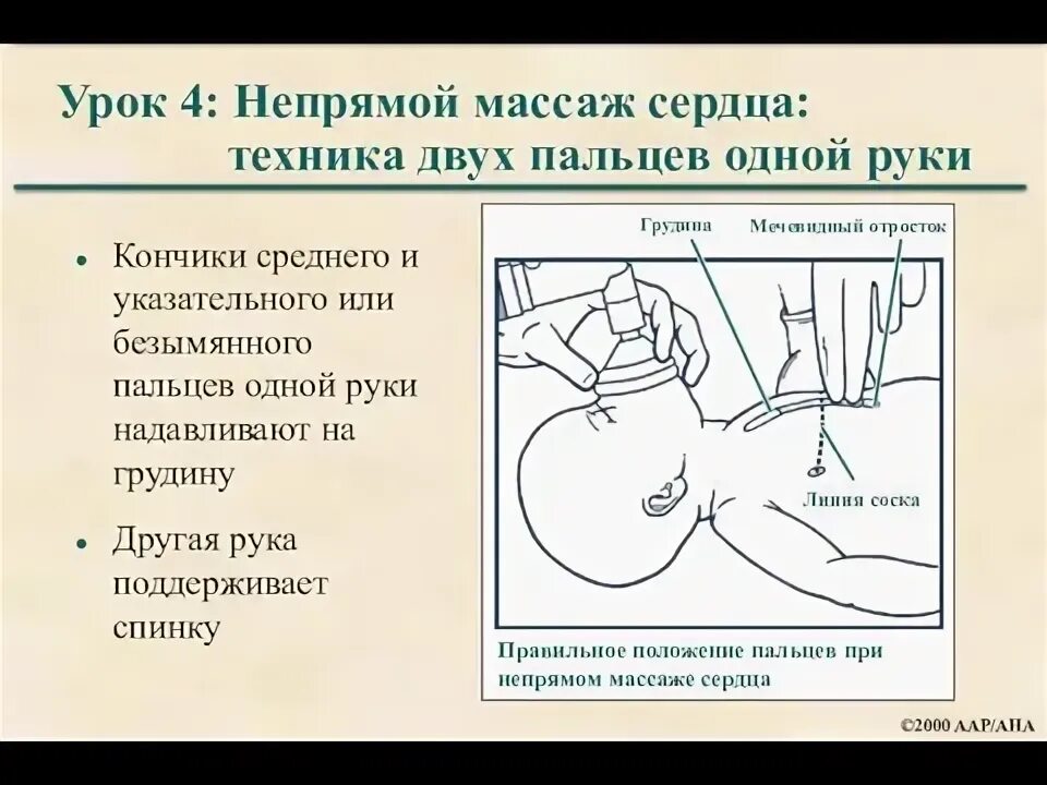 Картинки ОСЛОЖНЕНИЯ ПРИ ПРОВЕДЕНИИ НЕПРЯМОГО МАССАЖА СЕРДЦА
