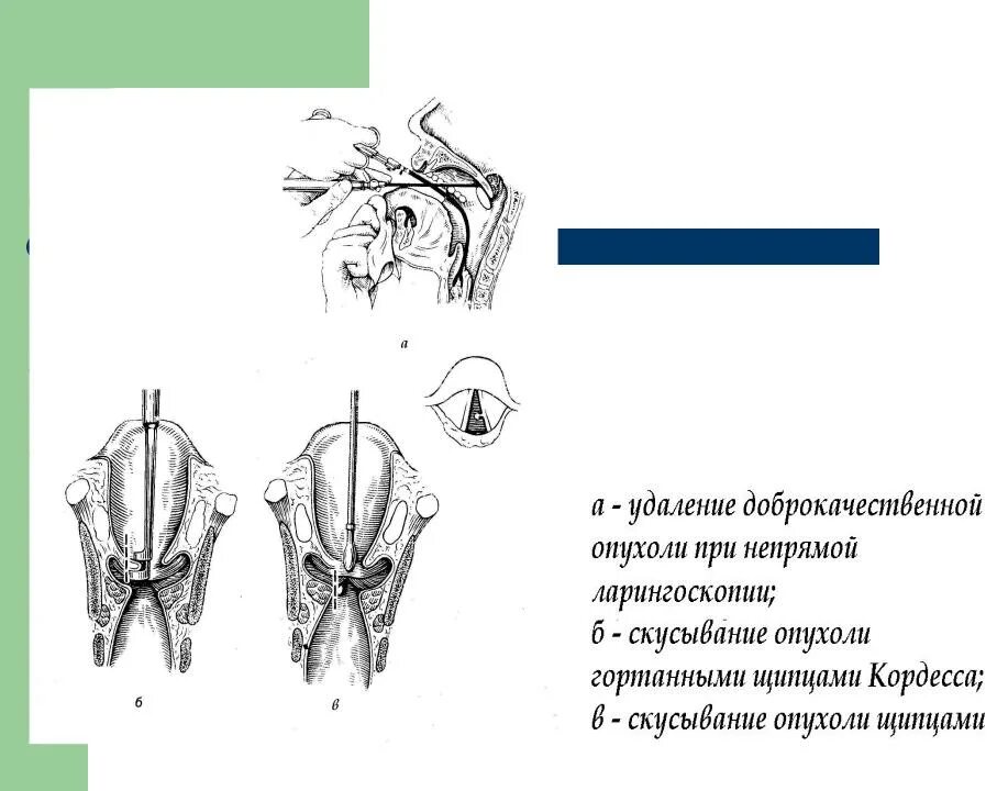 Гортань клиника. Доброкачественные новообразования гортани. Доброкачественные и злокачественные опухоли гортани. Резекция доброкачественной опухоли гортани. Доброкачественная опухоль в горле.