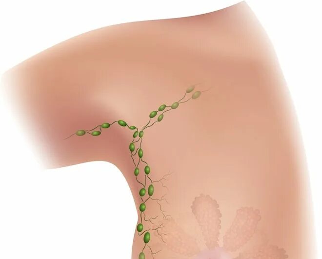 Лимфоузлы под мышками расположение у женщин. Гидраденит подмышечный лимфоузел. Лимфоузлы в подмышечной впадине. Лимфаденит подмышечных лимфоузлов. Подмышечная лифмоузлы.