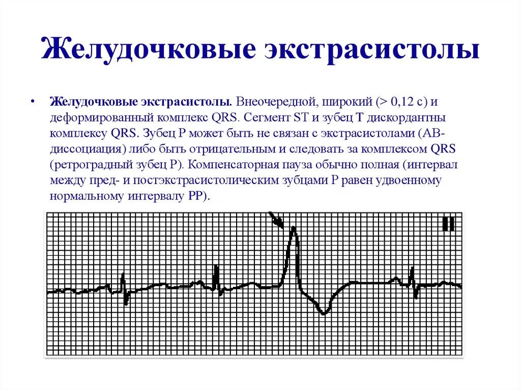 Желудочная экстрасистолия на ЭКГ. Желудочковая экстрасистолия на ЭКГ. Частые желудочковые экстрасистолы. Одиночные желудочковые экстрасистолы. Экстрасистолы много